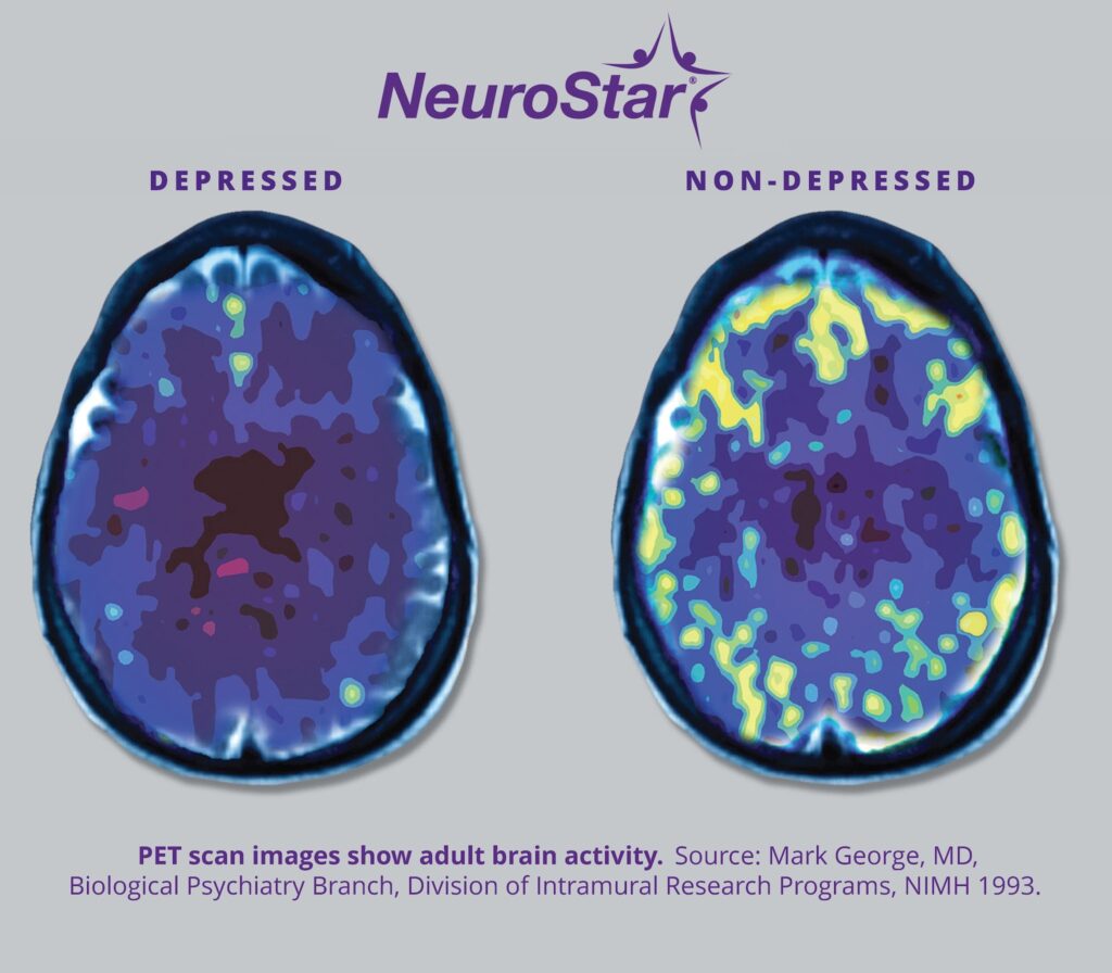 Long Does It Take for TMS to Work? PET scans comparing depressed and non-depressed adult brain activity levels.