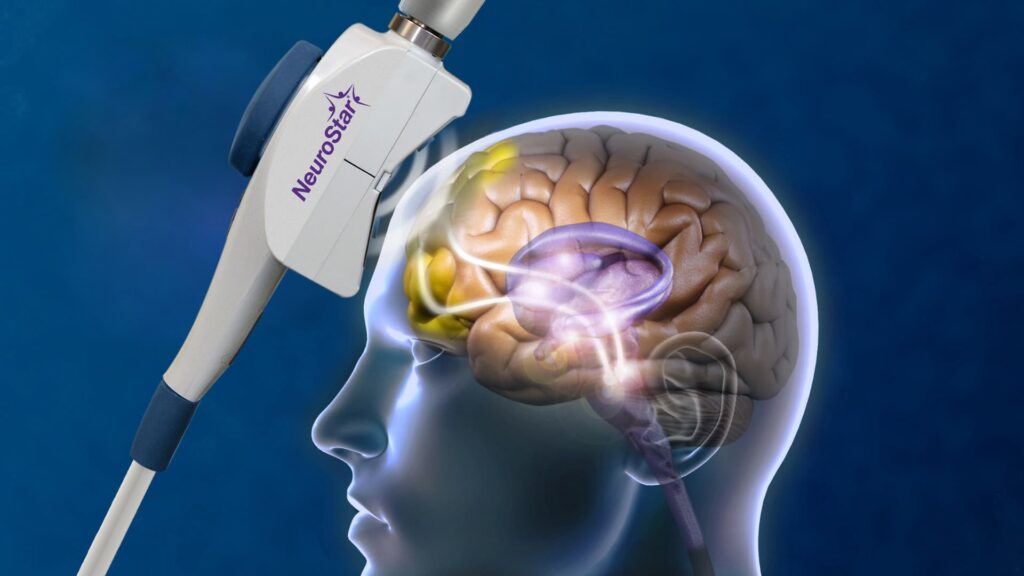 Diagram of a NeuroStar coil sending magnetic pulses into brain regions tied to mood, explaining how TMS treats depression.